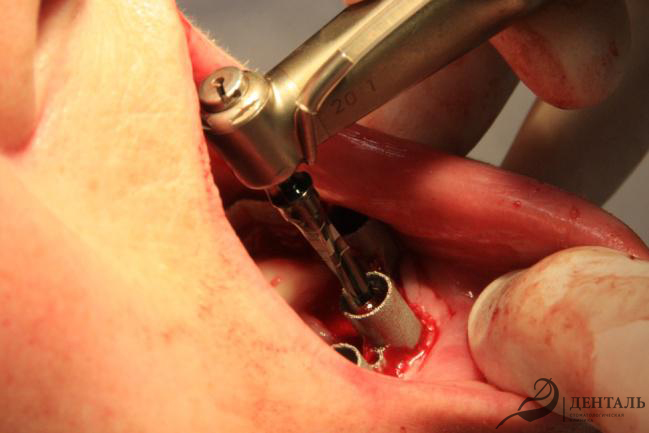 Имплантация по накостному хирургическому шаблону 