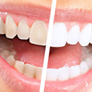 Комплексная чистка зубов