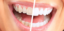 Комплексная чистка зубов